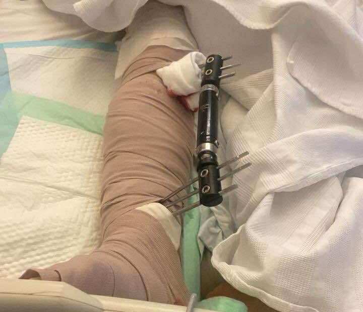 خلاف على صرف الدولار ينتهي ببتر ساق شاب سوري في بعلبك