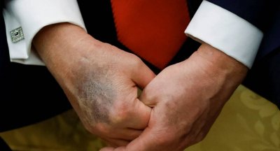 كدمة جديدة على يد ترامب تثير الجدل حول صحته (صورة)