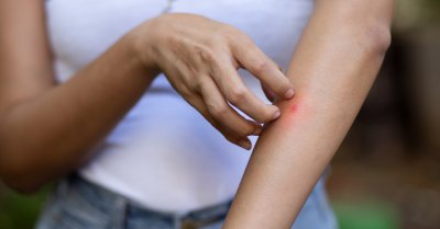 الملاريا تعود إلى لبنان... هل من داعٍ للهلع؟