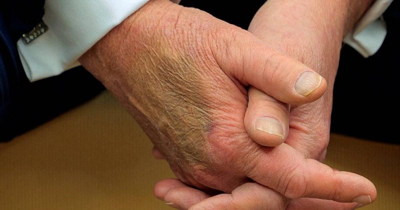 ضمادة يد ترامب تثير الجدل… والبيت الأبيض يوضح (صورة)