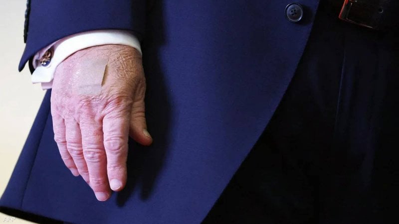 كدمات جديدة على يد ترامب تفتح باب التساؤلات حول صحته