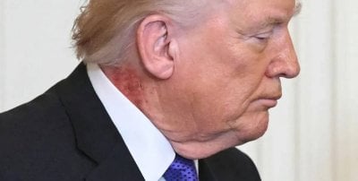 وسط التصعيد القائم… بقعة على رقبة ترامب تشغل الأوساط