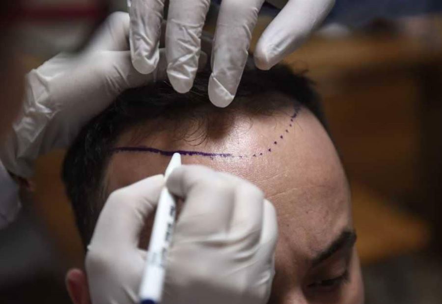  تقنية طبية تسمح بتخزين شعرك لـ"أيام الصلع"