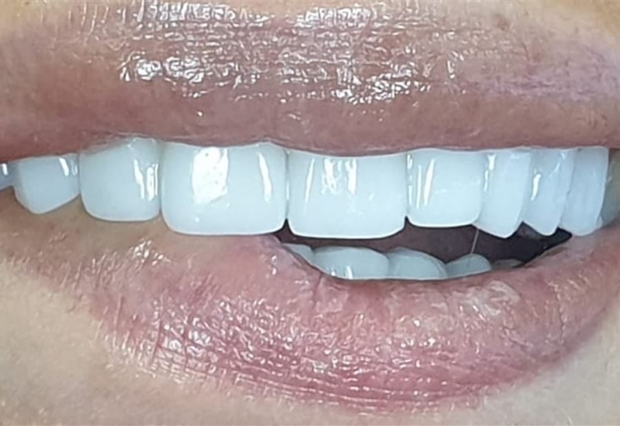 تقنية حديثة تغنيك عن الجراحة... استبدل أسنانك المفقودة بجلسة واحدة وبدقائق في Ortho Smile Clinics !
