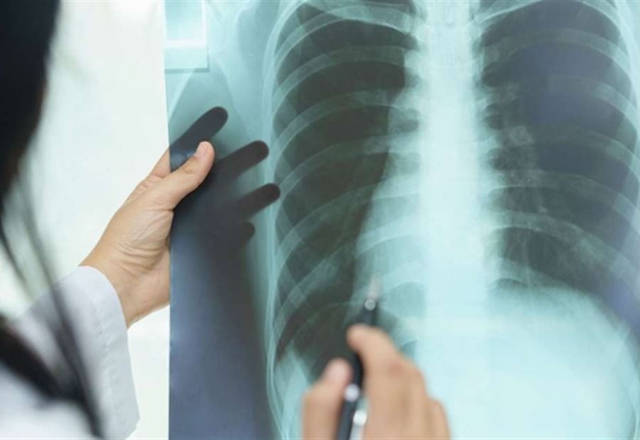 "علاج محتمل" لسرطان الرئة