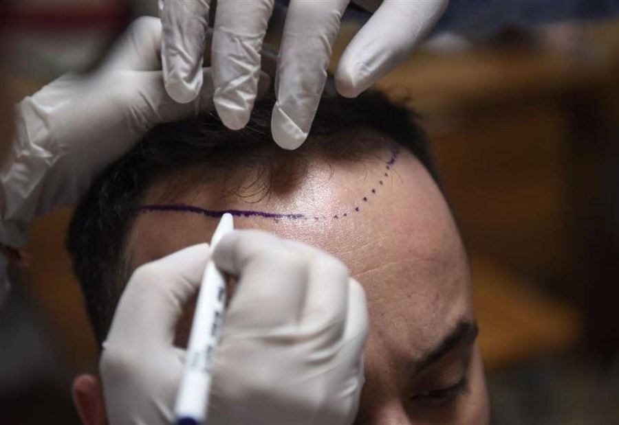 وفاة رجل خلال عملية زراعة شعر.. وخبراء يكشفون السبب