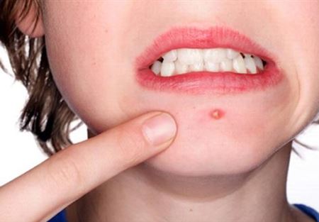 تخلصي من الحبوب الملتهبة بهذه الخطوات تخلصي من الحبوب الملتهبة بهذه الخطوات