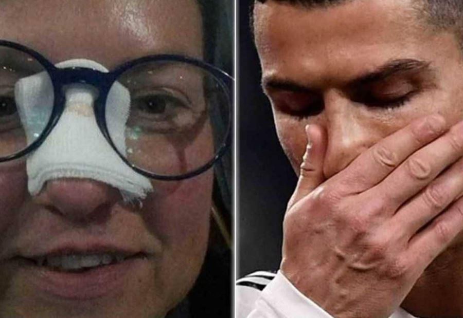 بعد أن كسر أنفها.. رونالدو يجبر خاطر "الضحية"