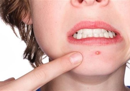 7 وسائل تحميك من ظهور البثور المزعجة