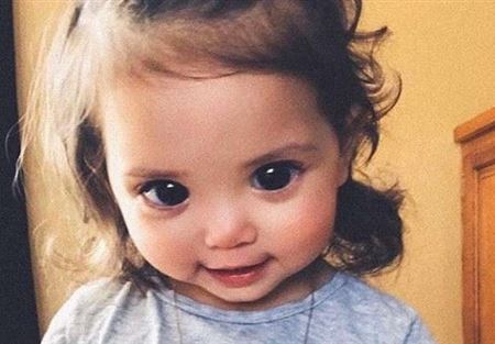 مرض نادر يعطي طفلة أميركية عيونا كبيرة مليئة بالألم