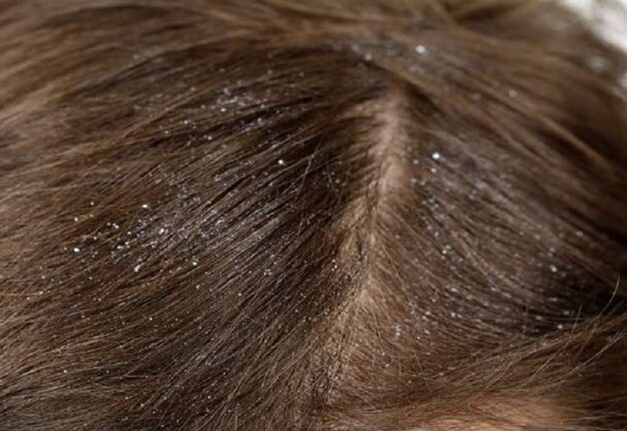 إحذر... قشرة شعر الرأس قد تكون علامة مرض خطير إحذر... قشرة شعر الرأس قد تكون علامة مرض خطير