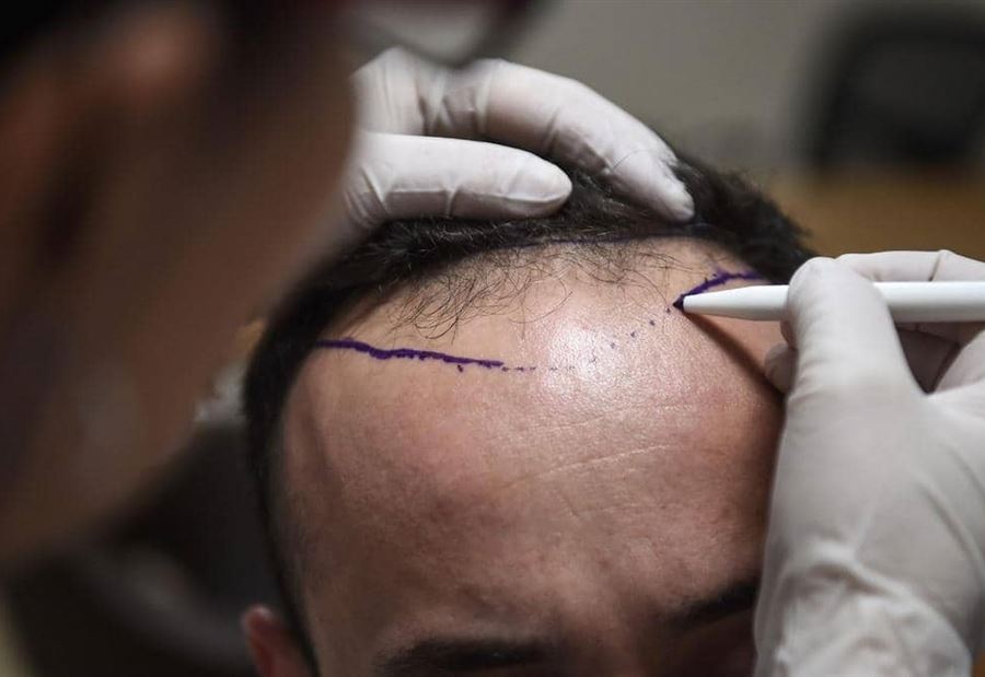 وفاة شخص في عملية زراعة شعر تحير الأطباء