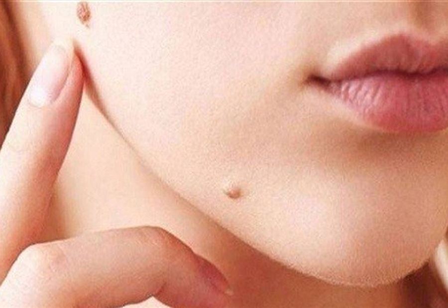 الأعراض الرئيسية لسرطان الجلد