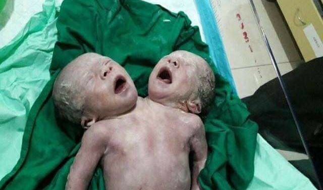 في حالة فريدة من نوعها في لبنان.. طفلان ملتصقان!