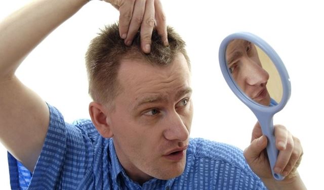 صفات الرجال المعرضين للصلع المبكر صفات الرجال المعرضين للصلع المبكر