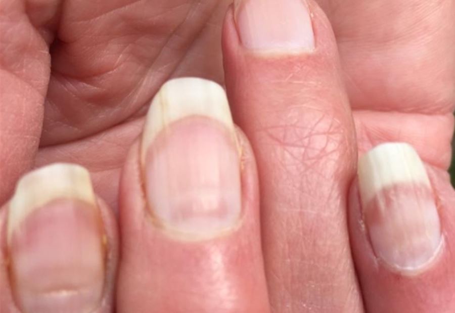 الكشف عن "كورونا" بواسطة الأظافر...