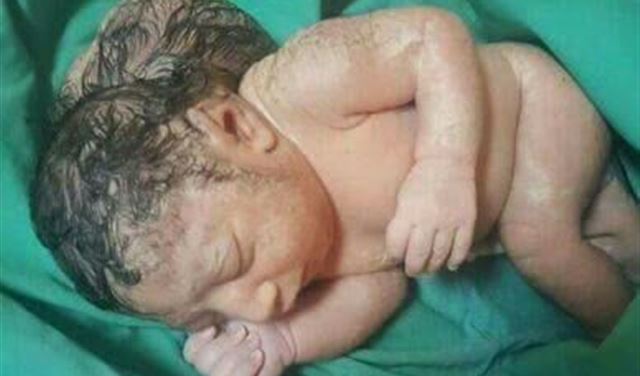 طفلة  ولدت برأسين في مستشفى ببعلبك.. وهذا ما حصل لها
