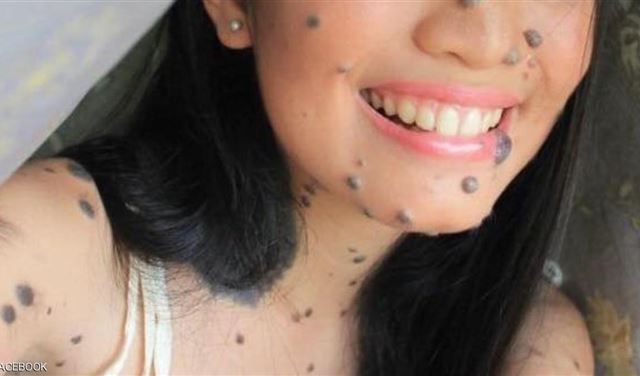 بقع إيفيتا لم تمنعها من  حلم "ملكة جمال الكون"