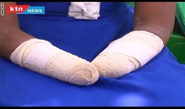 رجل قطع يدي زوجته بحجة عدم إنجابها