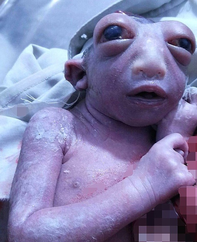 بالصور .. ولادة "طفلة معجزة" يثير صدمة في الهند 