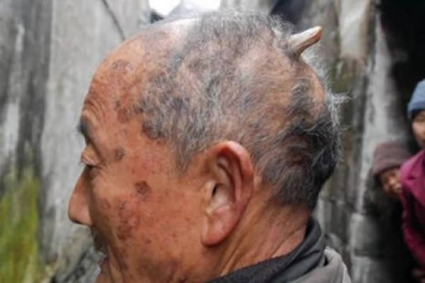 بالصور... قصص غريبة عن أشخاص نبتت لهم قرون !